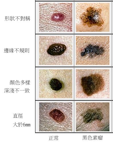 痣的顏色|痣 – 香港皮膚醫學慈善基金 HK Dermatology Foundation